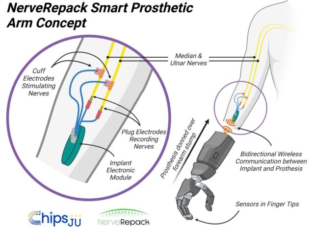 The NerveRepack prosthesis will be able to communicate wirelessly with an implant which transmits signals to and receives signals from nerves in the arm. This bidirectional communication will enable more intuitive use and increased patient autonomy.